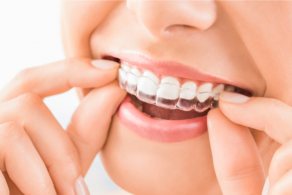 人気のマウスピース型矯正装置（インビザライン）治療の流れを解説